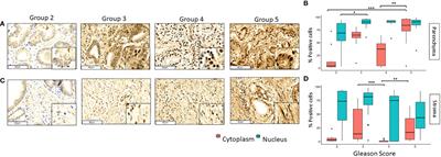 Positive correlation between the nuclear expression of GPER and pGLI3 in prostate cancer tissues from patients with different Gleason scores